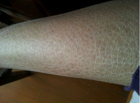 小腿皮膚像魚鱗 (9) 