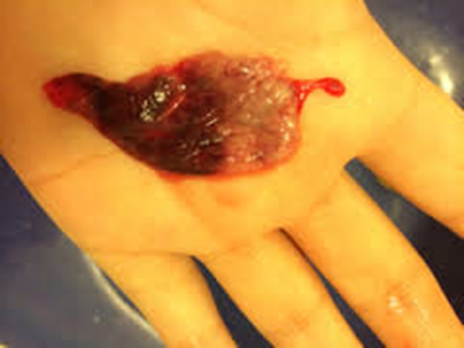 早孕藥流排出的孕囊實體的