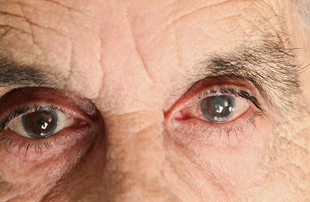 白內障的早期症狀