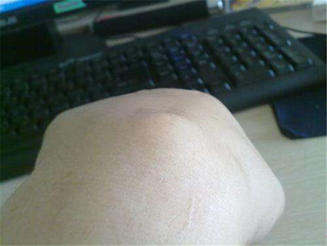 左手腕處的手腕腱鞘炎