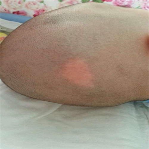 腦後皮脂腺痣切除後