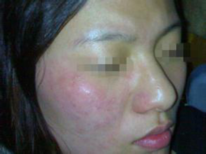 藥物性皮炎症狀