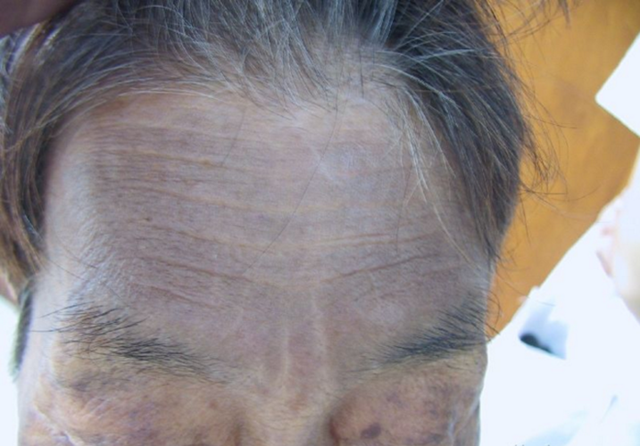 額頭皮膚黑變病嚴重