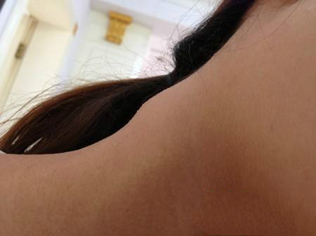 慢性淋巴結炎 (39) 