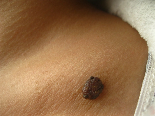 黑痣癌變