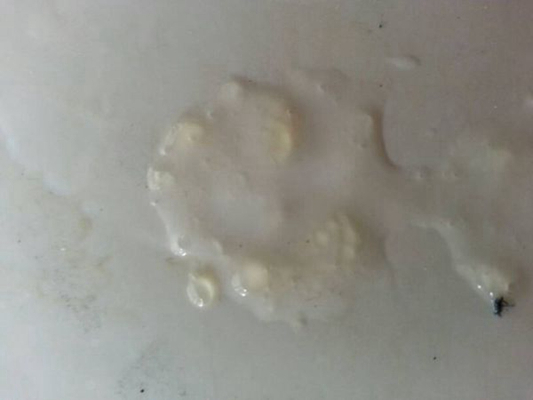 不正常精液液化