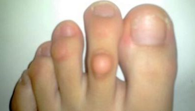 胼胝體的發育不良