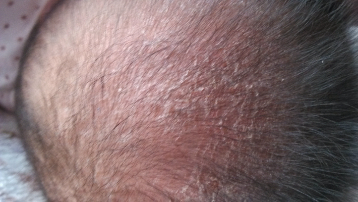 頭皮脂溢性皮炎 (34) 