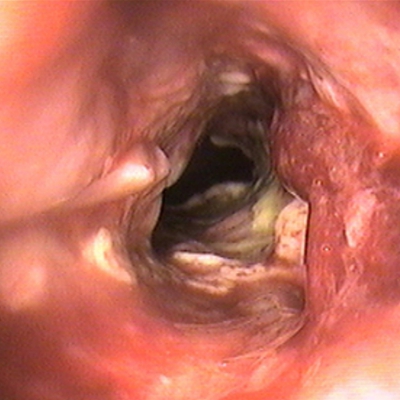 直腸癌晚期症狀 (9) 