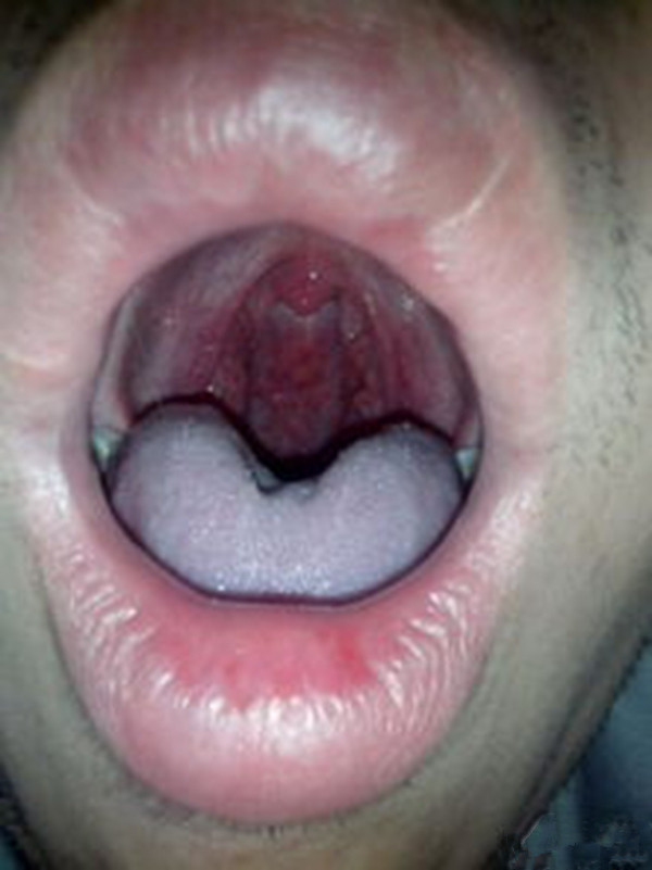 疑似喉血管瘤的