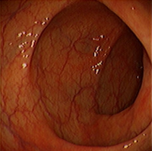 急性胃炎陽性表現的