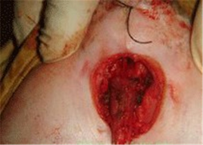 小二尿道下裂發病