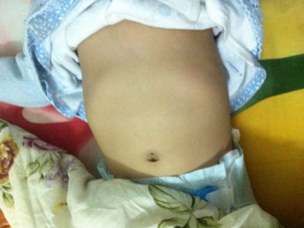 寶寶缺鈣雞胸圖 (53) 