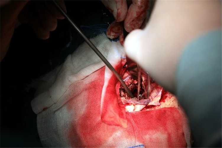 由高血壓腦血管痙攣引發的腦出血治療