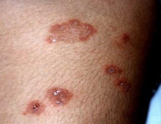 皰疹樣皮炎局部症狀