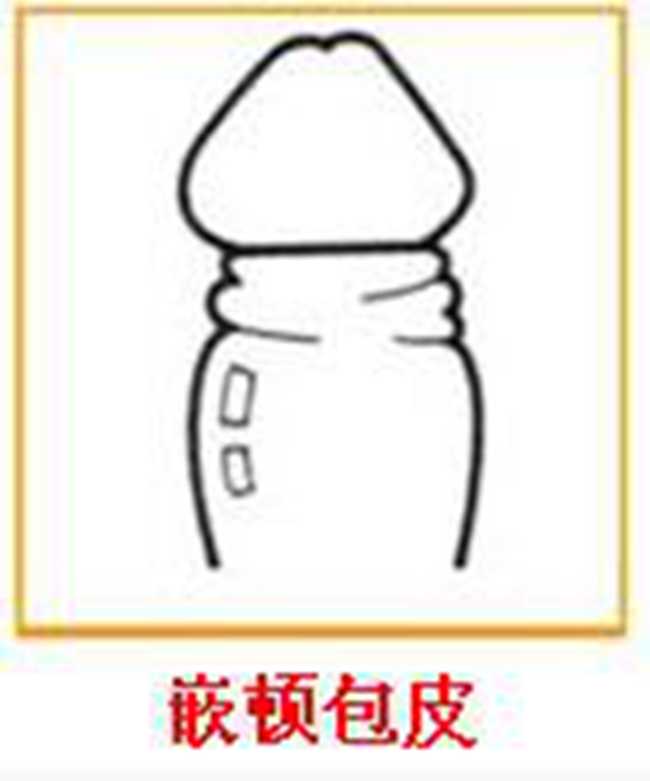 嵌頓包莖鬆解術步驟 