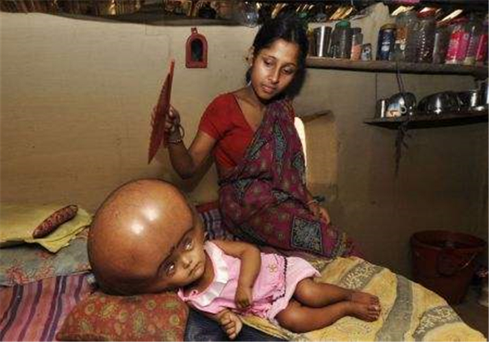 重度腦積水什麼樣