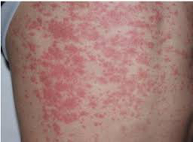 背部疙瘩嚴重異位性皮炎