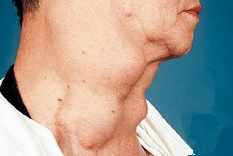 男性喉腫瘤的症狀