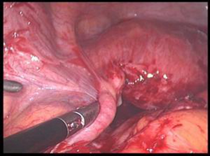 治療巧克力囊腫的