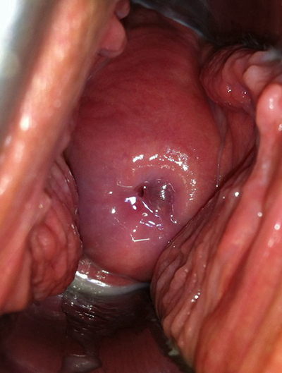 子宮肥大圖 (44) 