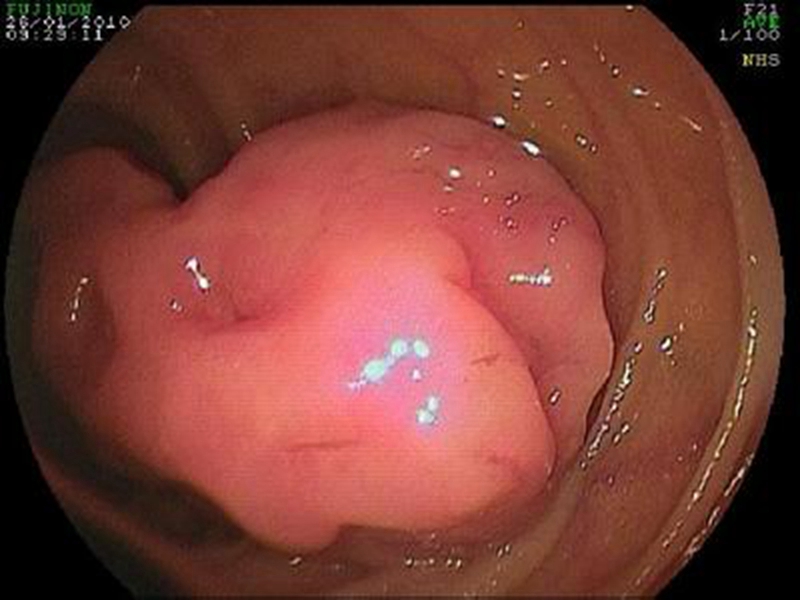 直腸腸腫瘤後期