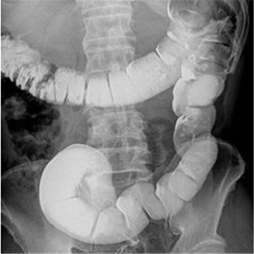 潰瘍性結腸炎影像檢查