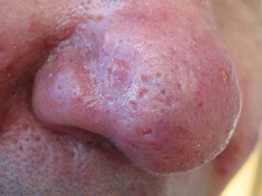 鼻子長蟎蟲症狀