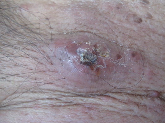 黴菌性龜頭炎 (49) 