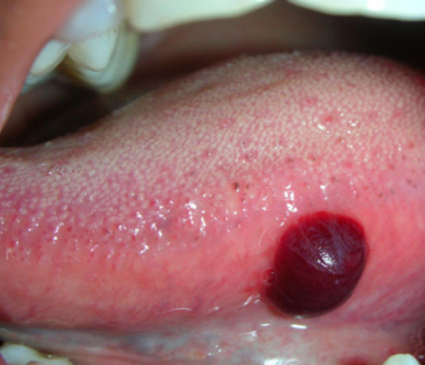 口腔癌的前兆 (6) 