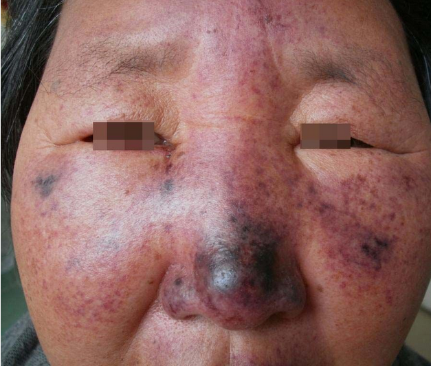 臉部植物日光性皮炎