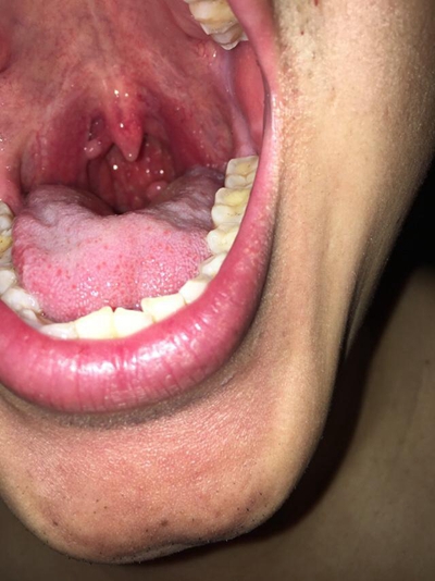 口腔癌的前兆 (48) 