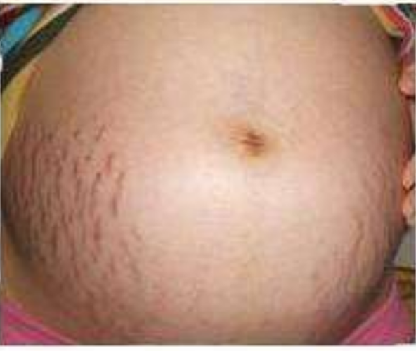 肚皮懷孕期妊辰紋