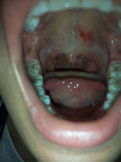 口腔癌的前兆 (53) 