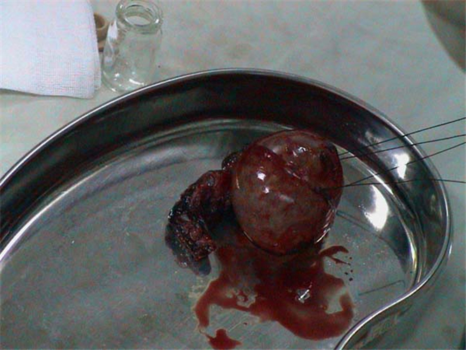 切除了的宮外孕