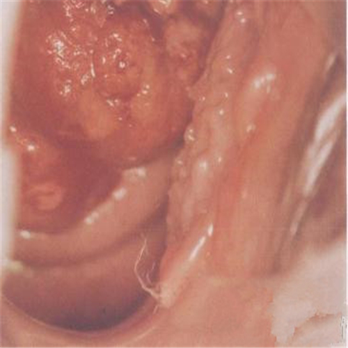 溼疹導致外陰瘙癢的症狀