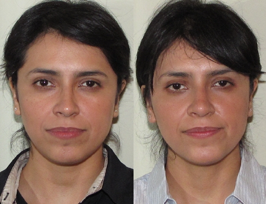 鼻中隔彎曲手術圖解 (33) 