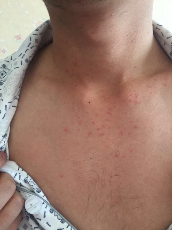 症狀流感成人真實