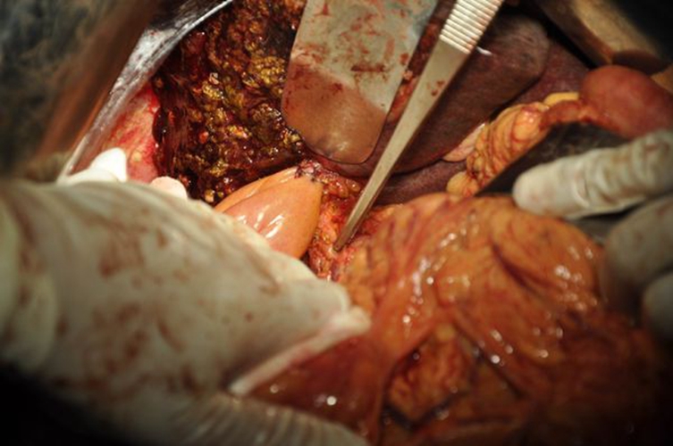 肝內膽管癌末期