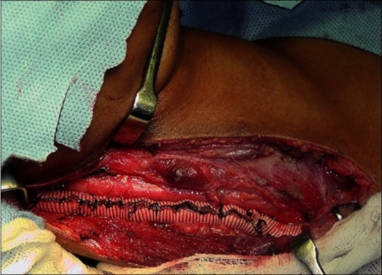 頸靜脈怒張 (48) 