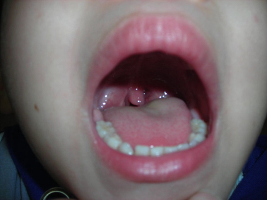 扁桃體癌圖  (55) 