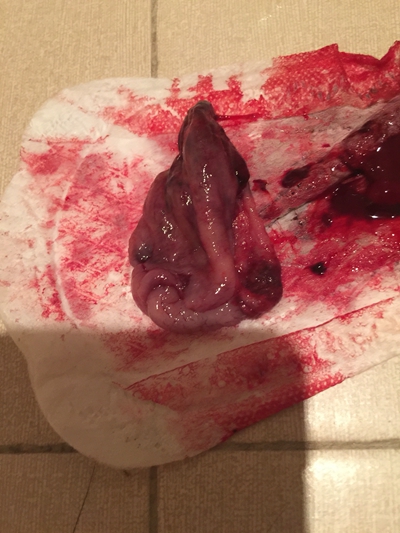 流產掉下來的孕囊