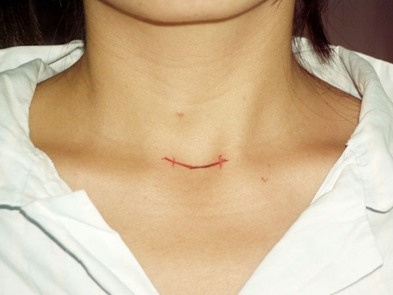 橋本甲狀腺炎症狀手術