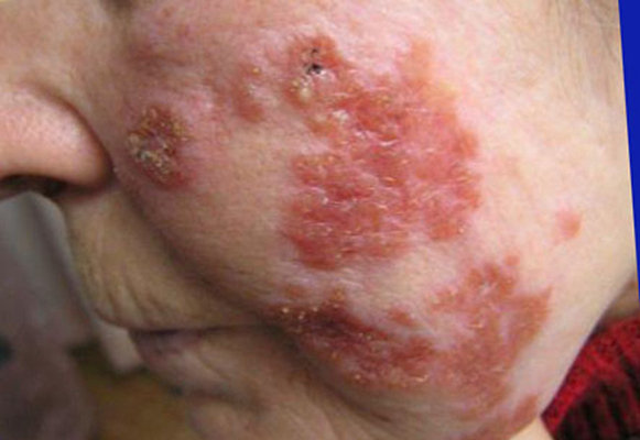 帶狀皰疹樣外觀