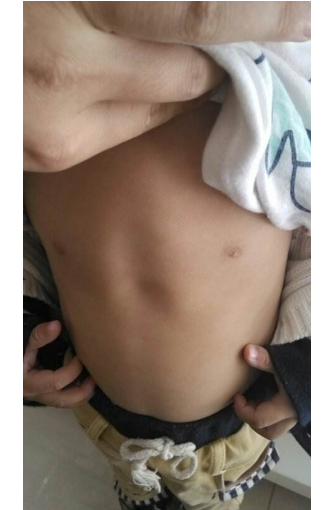 寶寶缺鈣雞胸圖 (45) 