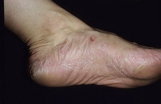 足蘚初期症狀
