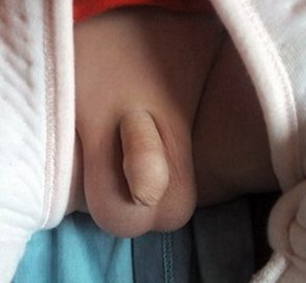 男寶寶疝氣的症狀