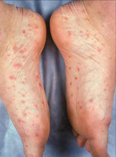 艾滋病紅疹症狀