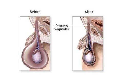 精索曲張睪丸下墜時