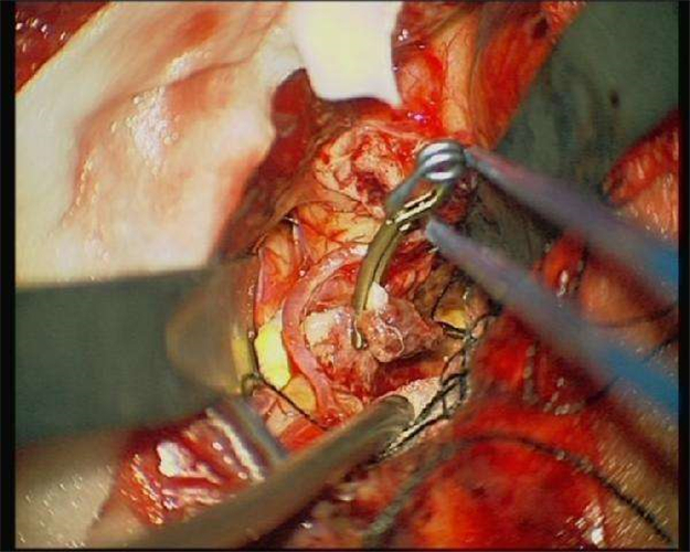 腦血栓性動脈瘤治療